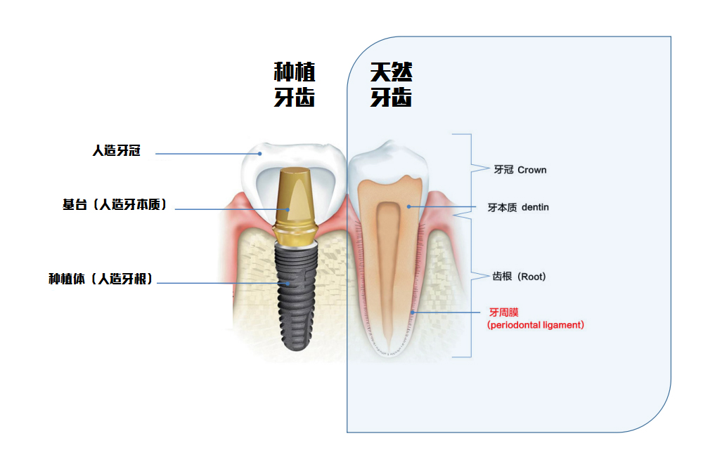 种植牙结构
